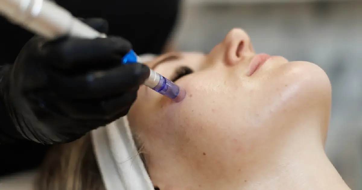Does Microneedling Really Work for Acne Scars?